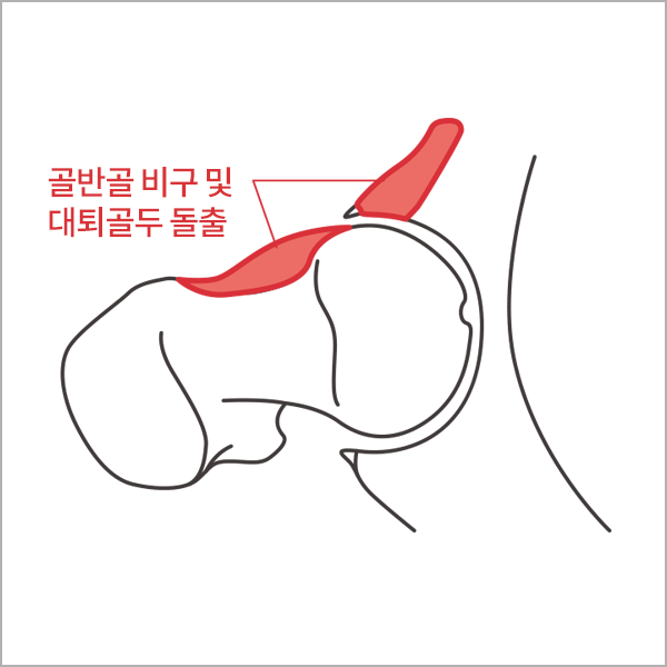 고관절